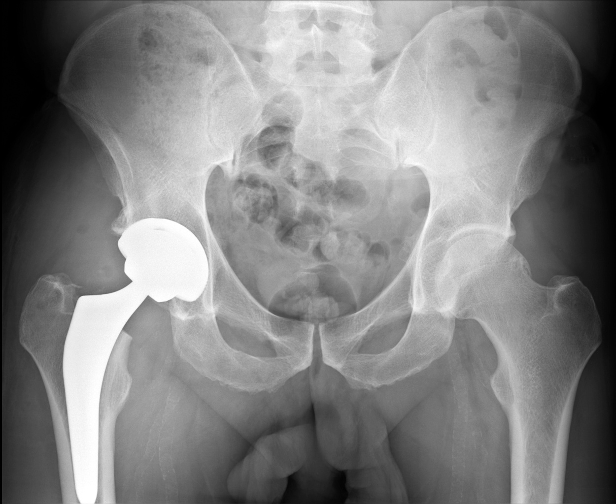 total hip arthroplasty coxarthrosis