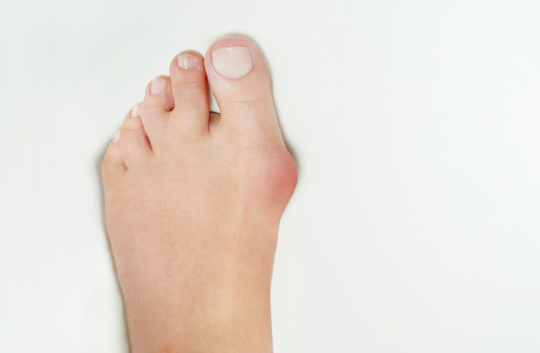 Hallux valgus, bunion in woman foot on white background